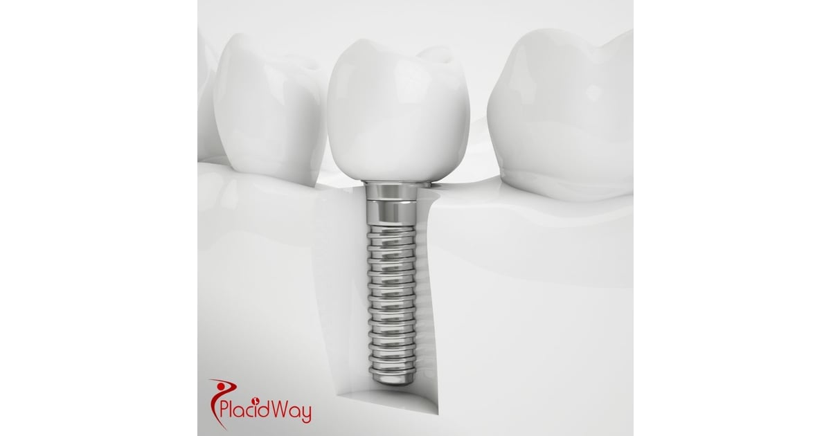 Dental Implants in Turkey: Why German Patients Choose All-on-4 Implants for a Full Smile Restoration