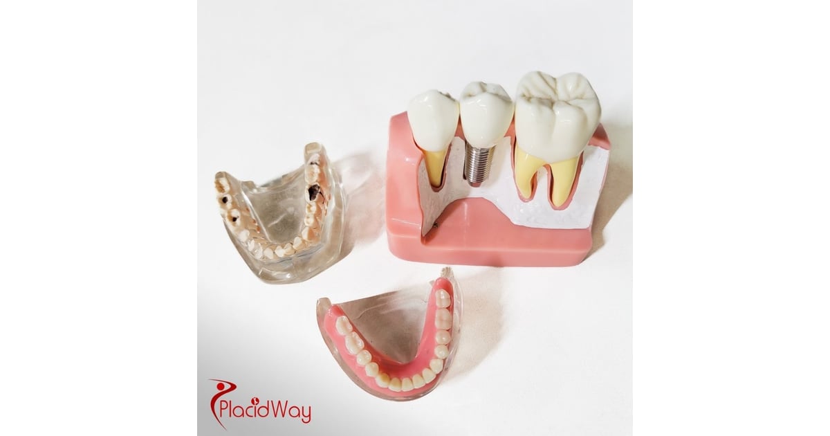 Dental Implants in Colombia: Affordable Solutions for Illinois Patients