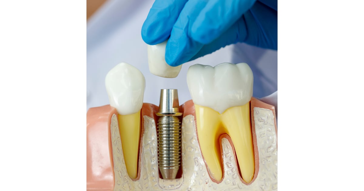 Implantes dentales All-on-4: México vs. EE. UU. - Guía completa