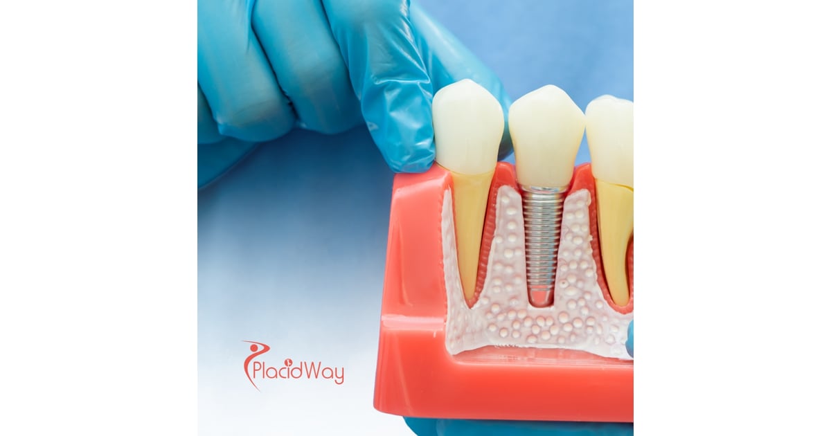 All-on-4 Dental Implants for Vancouver Patients in Tijuana, Mexico