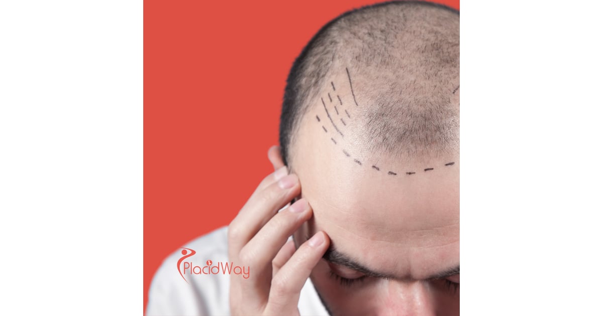 Hair Transplants in Turkey: Affordable Hair Restoration for Bahrain Men with Male Pattern Baldness