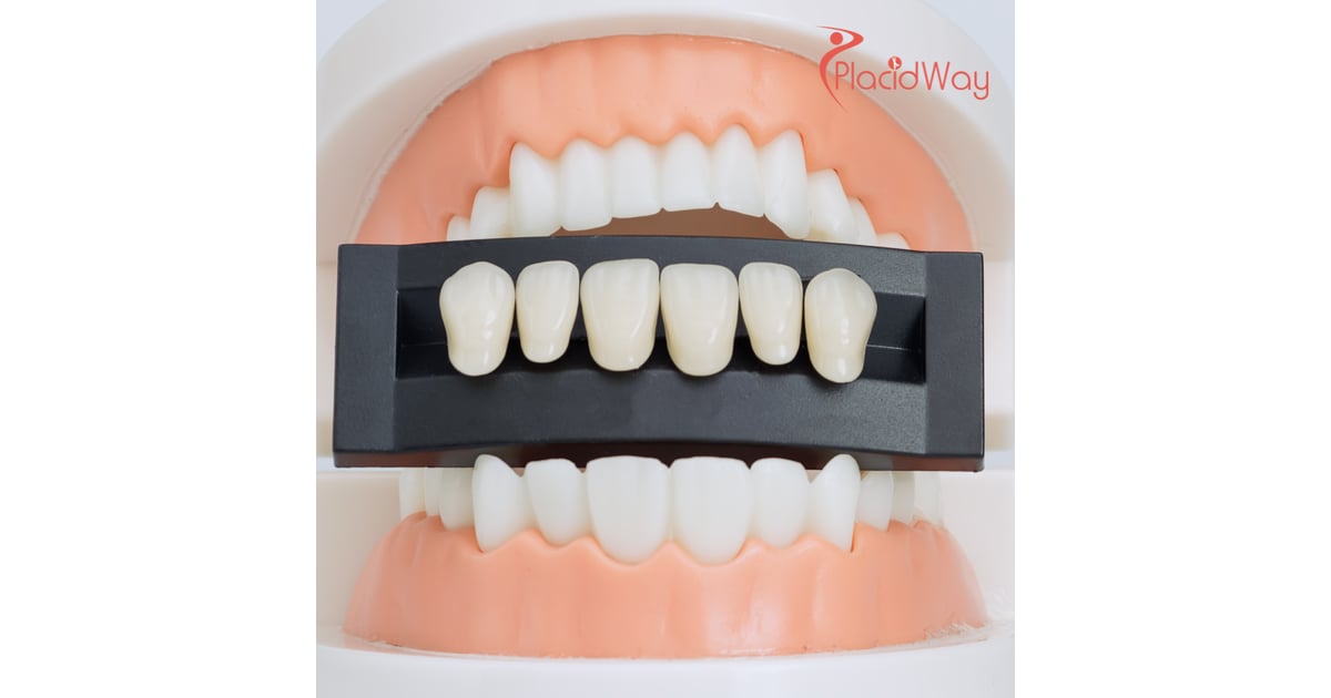 Why Kiwis are Choosing Thailand for Dental Veneers: A Comprehensive Guide
