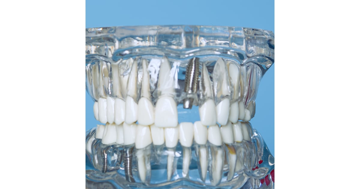 Dental Crowns in Los Algodones, Mexico: Top Affordable Clinics for Californians