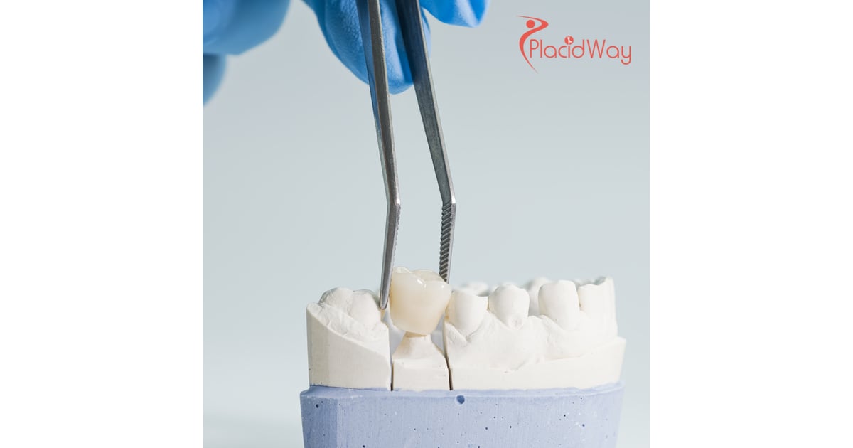 Get Your Smile Back: Affordable Dental Bridges in Thailand for New Zealanders