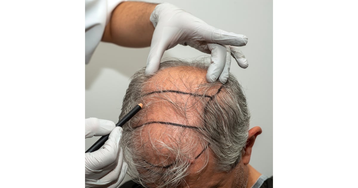 Hair Transplant in Turkey vs UK - Why More People Are Choosing Turkey
