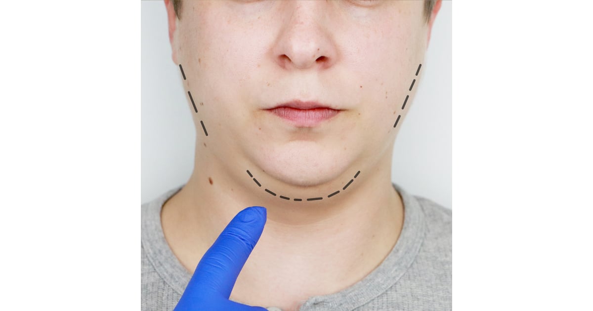 Facelift Surgery in Vietnam vs Australia – Which Is Safer and More Affordable?