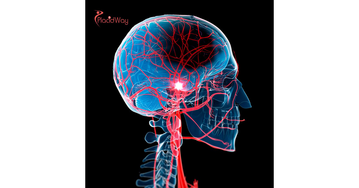 Stem Cell Therapy for Stroke Recovery in Mexico: The Complete Guide to Advanced Regenerative Treatment