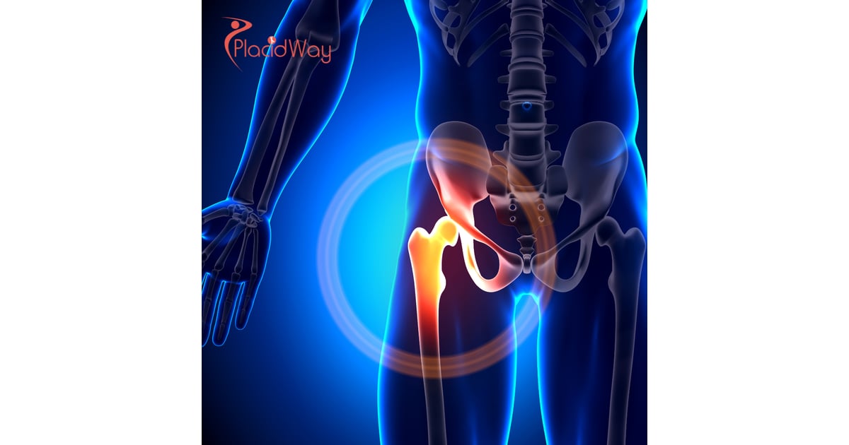 Recuperación más rápida y alivio del dolor: terapia con células madre para problemas de rodilla y cadera en México