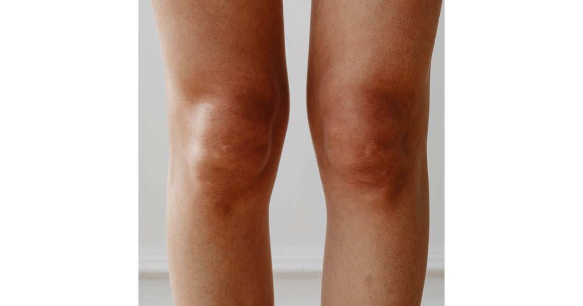 Bow Leg & Knock Knee Correction in Turkey for Kuwaiti Patients – Perfect Alignment Results
