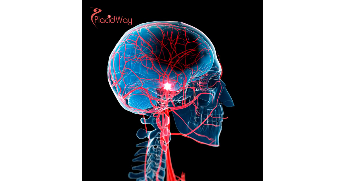 Stem Cell Therapy for Stroke in India: Costs, Success Rates & Recovery Guide