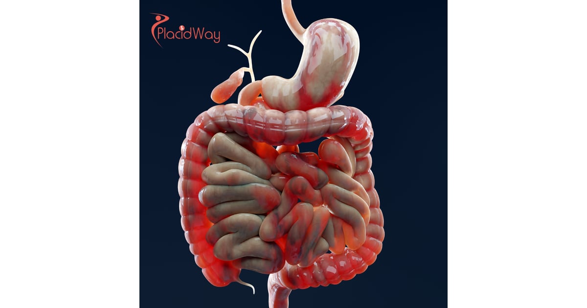 Advanced Crohns Disease Stem Cell Therapy in Japan: A Complete Guide
