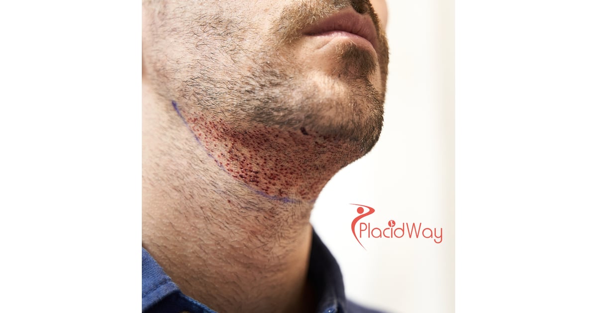 Beard Hair Transplant in Turkey for US Patients