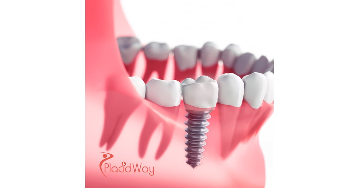 Dental Implants in Mexico for Toronto Patients Facing High Dental Costs