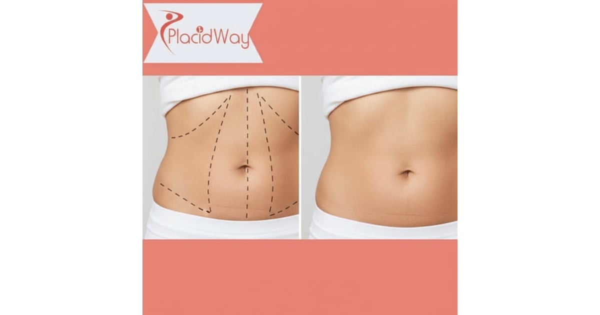 Tummy Tuck Surgery in Turkey for Adelaide Patients After Weight Loss 