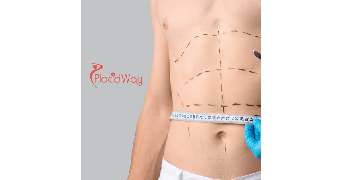 Abdominoplasty (Tummy Tuck) in Turkey for Stuttgart Patients Following Weight Loss
