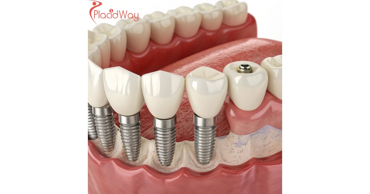All-on-6 Dental Implants in Turkey for Munich Patients with Missing Teeth