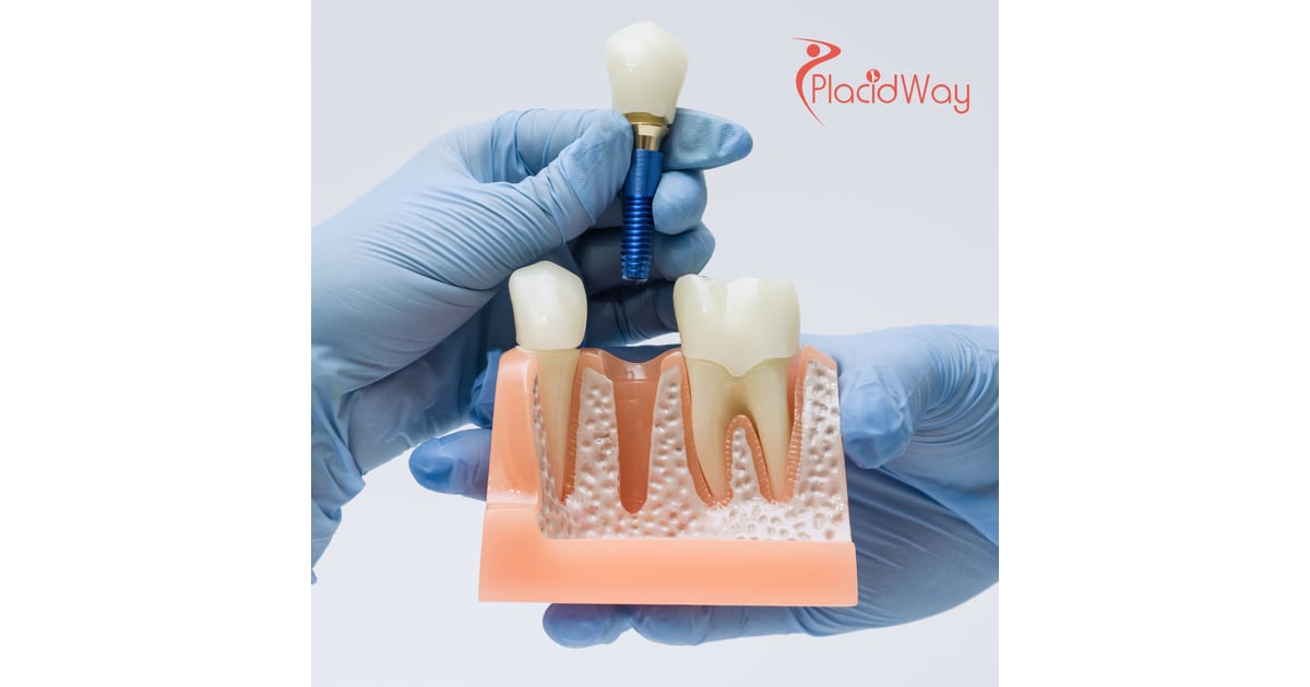 Full Mouth Restoration in Mexico for Edmonton Patients