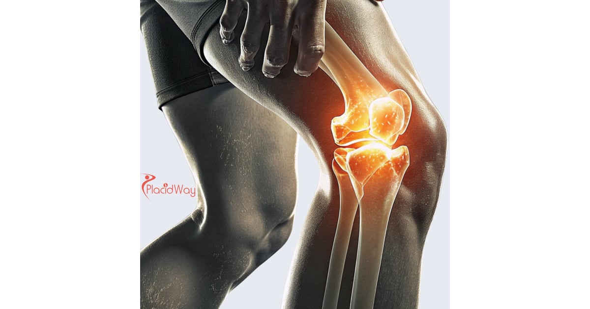 Stem Cell Therapy for Knee Arthritis in Mexico for US Patients