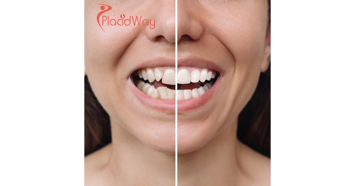Porcelain Veneer Smile Design in Mexico for U.S. Patients
