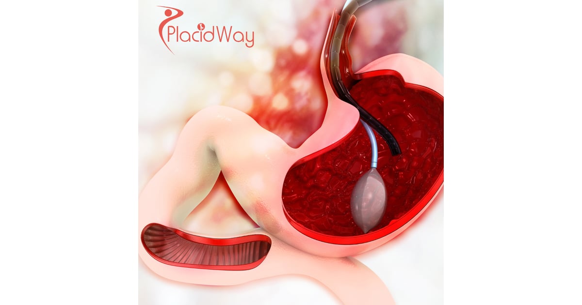Non-Surgical Gastric Balloon Treatment in Mexico for U.S. Patients