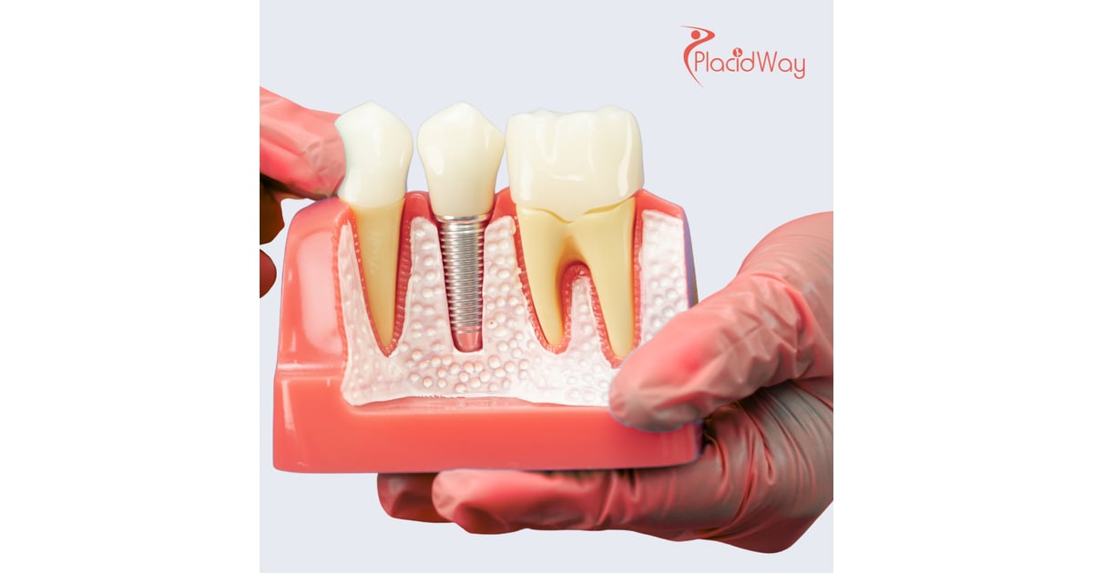 Dental Implants in Mexico (Los Algodones) for San Diego Patients Saving on Dental Costs
