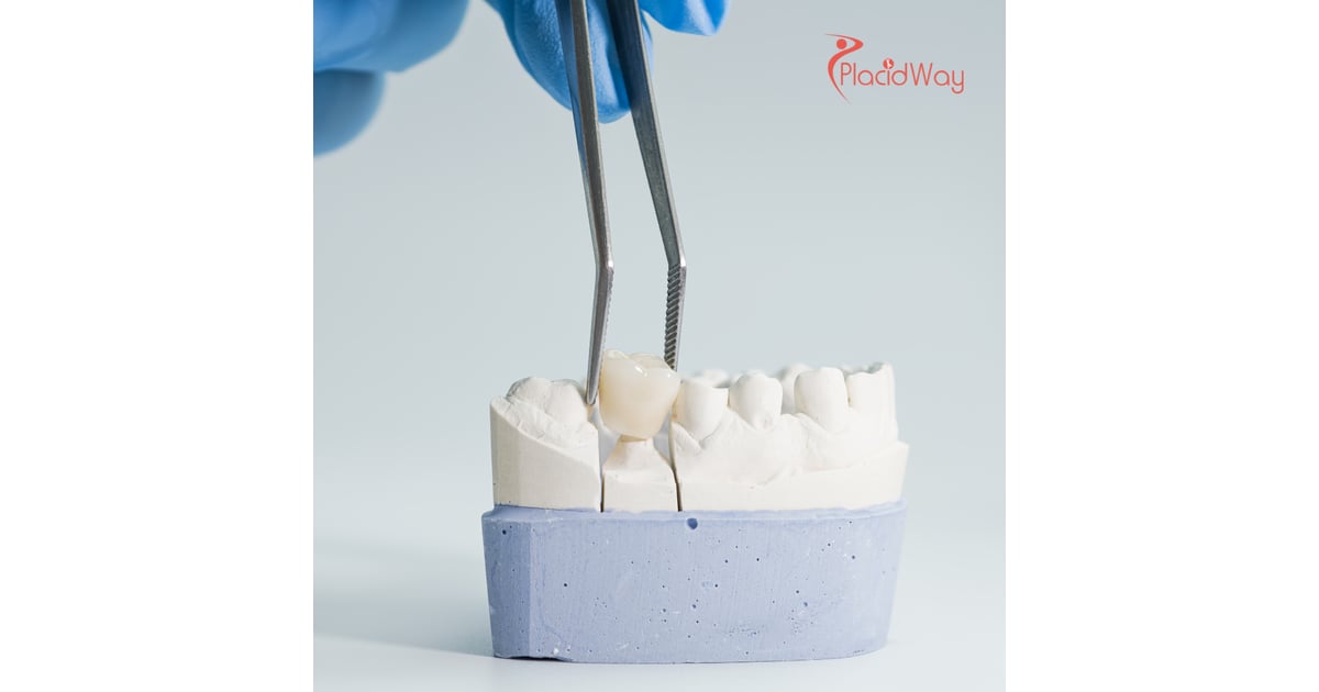 Dental Crown and Bridge Treatment in Mexico for U.S. Patients