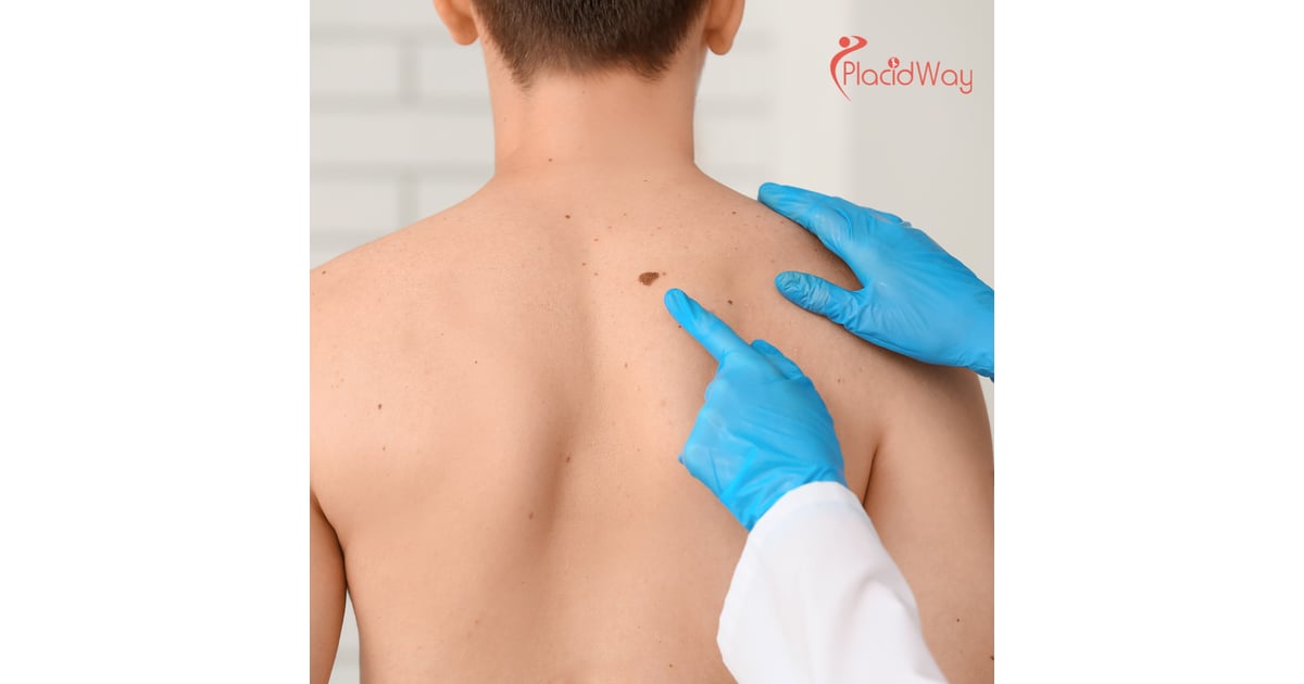 Advanced Melanoma Treatment in Tijuana - Targeting Metastasis When Standard Care Fails