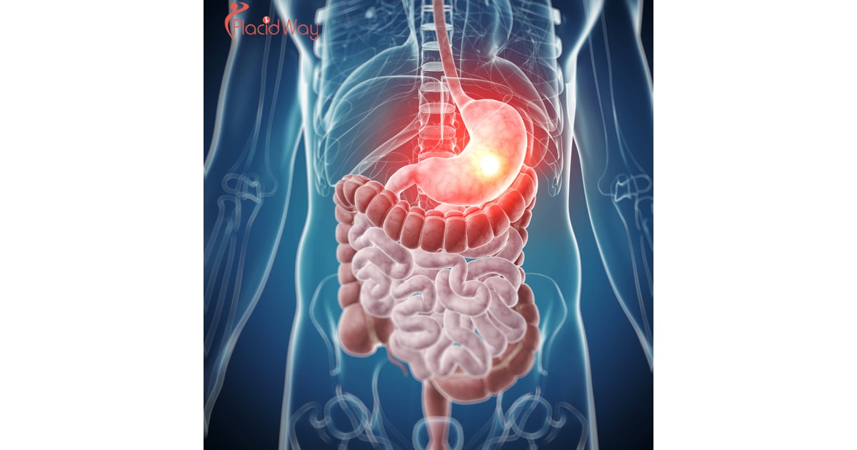 Alternative Stomach Cancer Treatment in Tijuana - Restoring Digestive Health