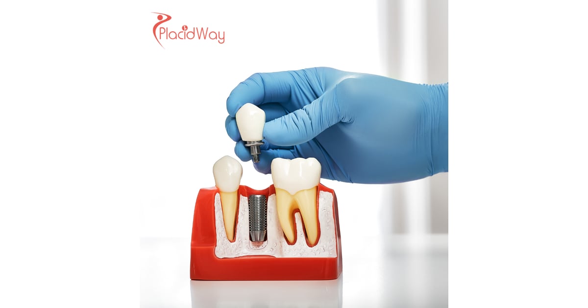 The New Dental Hub: Why UAE Residents Are Flocking to Georgia for Premium Dental Implants