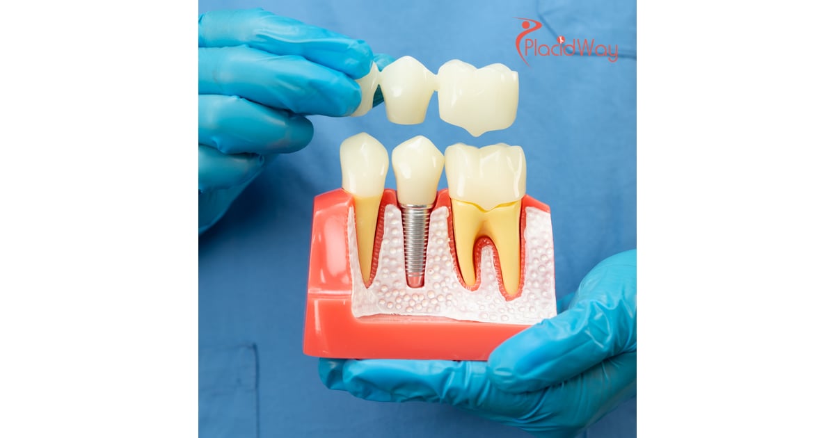 Capitalizing on EU Cross-Border Care: German Medical Tourists Drive Record Demand for Premium Dental Crowns in Croatia
