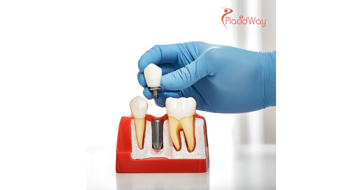 A Growing Trend: Russian Patients Choose Georgia for World-Class Dental Implant Procedures