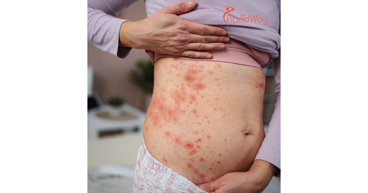 Clear Skin Awaits: U.S. Psoriasis Patients Are Finding Real Relief in Mexico’s Stem Cell Clinics!