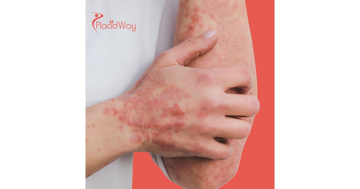 Psoriasis Doesn’t Have to Win: Why Americans Are Turning to Immune-Level Strategies in Mexico for Skin Balance