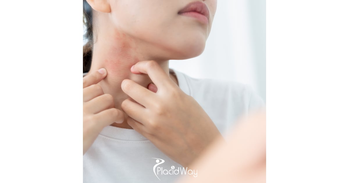 Lupus? Stem Cells in Mexico Are Helping U.S. Patients Turn Their Lives Around!