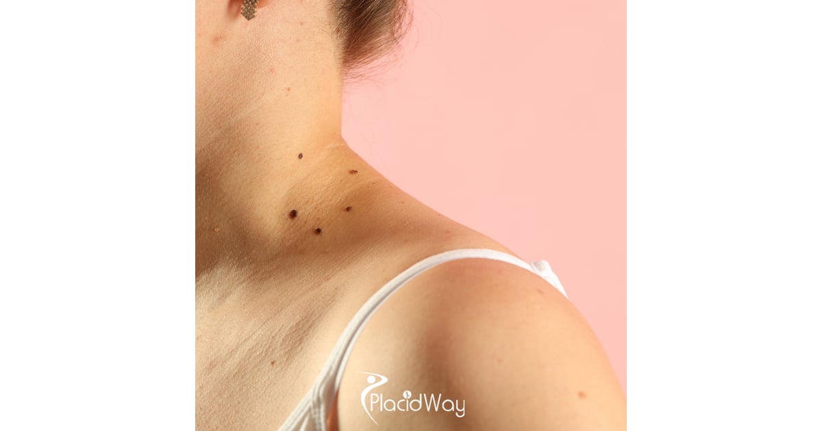 Melanoma Treatment Solutions: How U.S. Patients Are Finding New Hope in Mexico’s Clinics