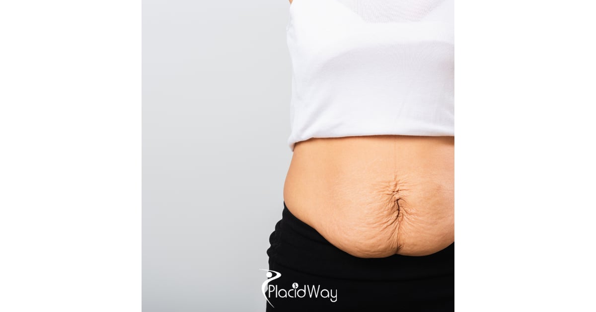 Tummy Tuck in Mexico vs USA - How American Moms Are Avoiding $12,000 Surgical Bills