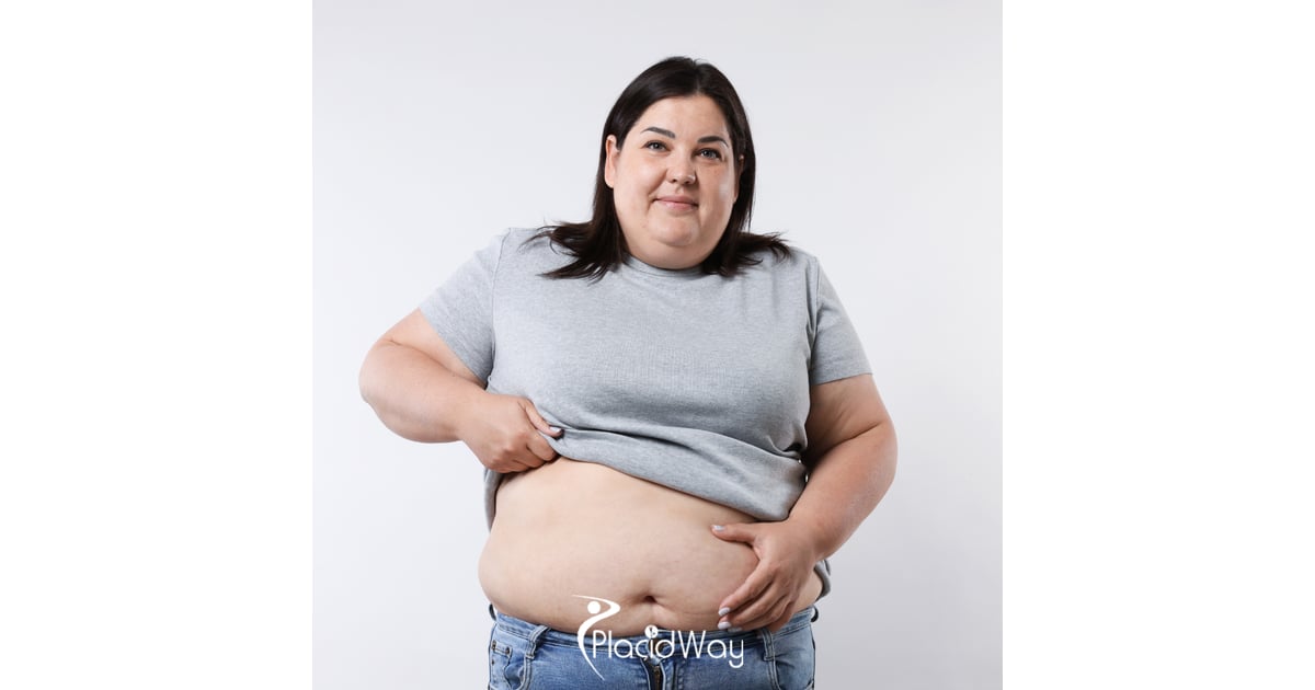 Gastric Sleeve in Turkey vs UK - Bypassing 36-Month NHS Wait Times for British Patients, Brands, and Quality Standards Compared