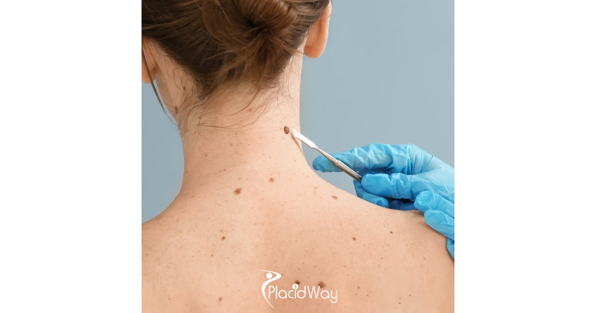 Melanoma That Has Spread Beyond the Skin: Advanced Treatment Options in Mexico