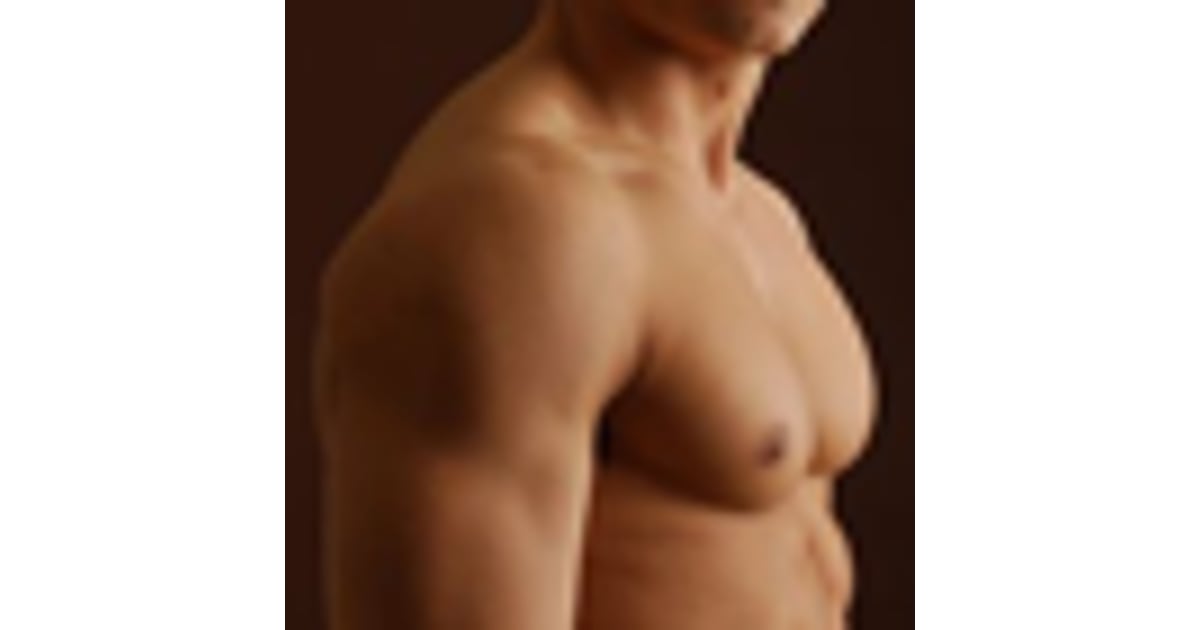Must-Know Aspects about Gynaecomastia Surgery in Mexico