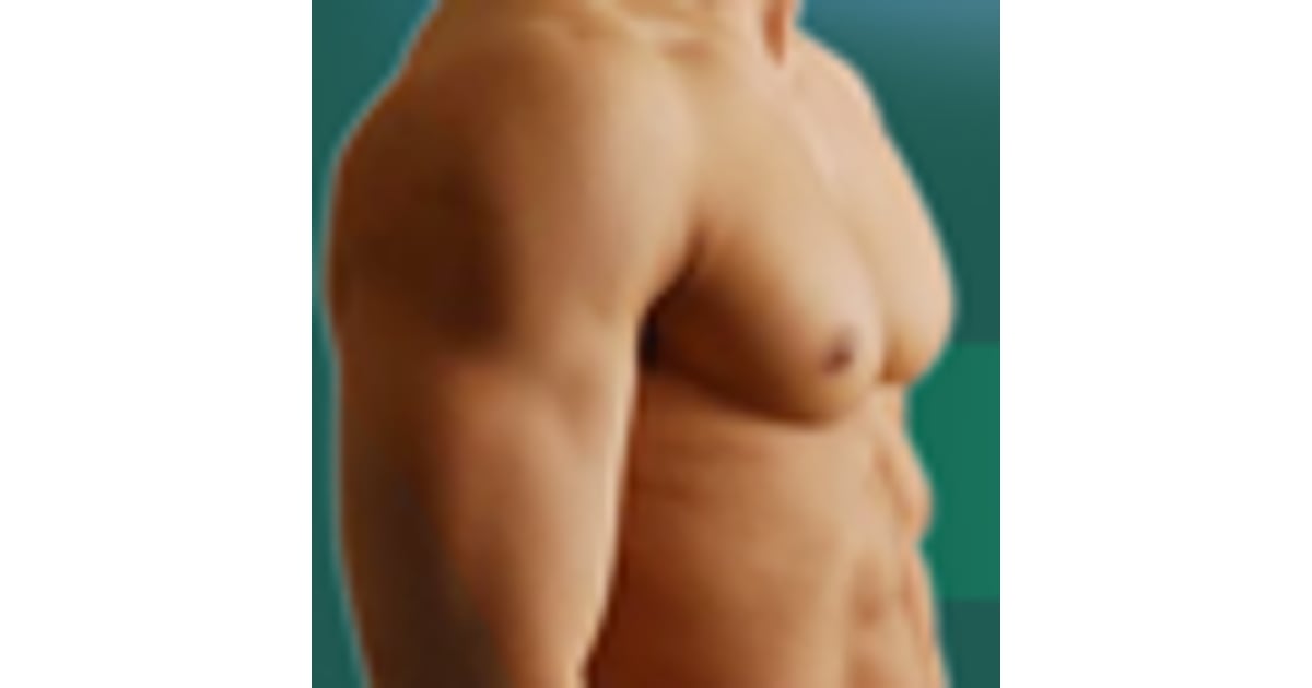 Effective Gynecomastia Surgery in India- Things to Know