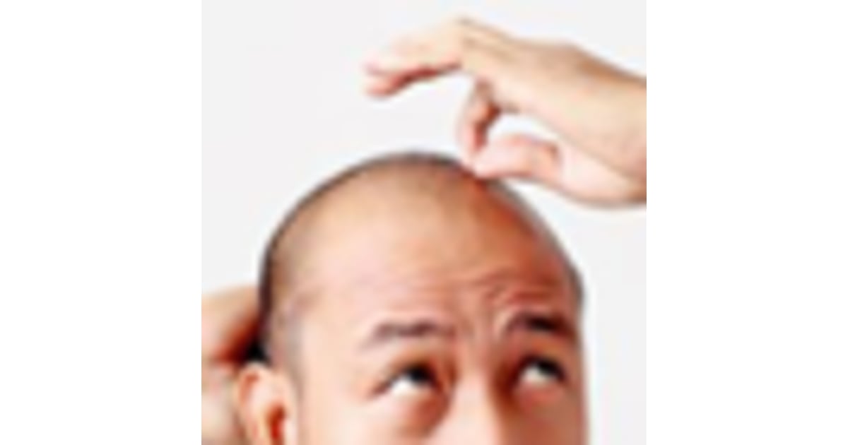 Top Questions for Surgeon before Hair Transplant in Tijuana, Mexico