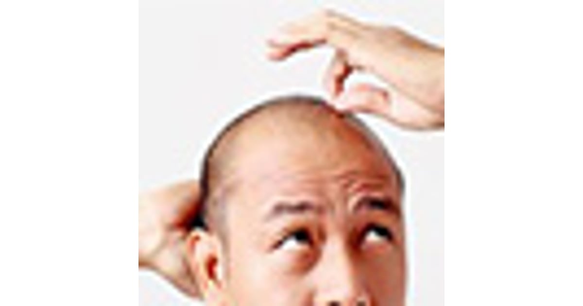 What is the Difference between a Hair Transplant and Hair Plugs