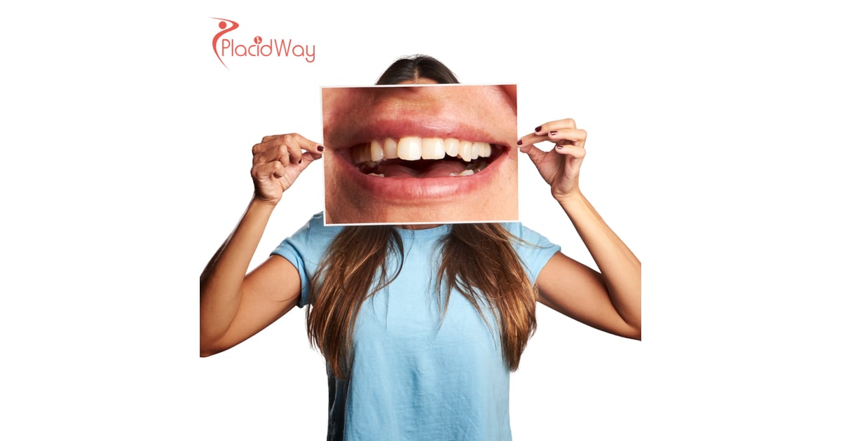 Vietnam’s All-on-4 Revolution: Why Thousands of Australians are Choosing Ho Chi Minh City for Full-Mouth Restorations in 2026