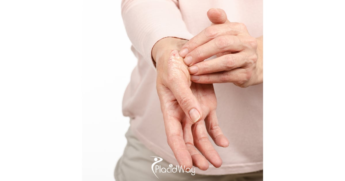 The End of Psoriasis Plaques? How Mexico’s Cutting-Edge Immune Therapies Are Drawing US Crowds