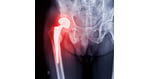 Hip Resurfacing in Istanbul: Cutting-Edge 2026 Techniques