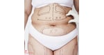 Liposuction in Thailand: Exploring Cosmetic Surgery Planning, Recovery Requirements, and Patient Considerations