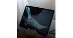 Orthopedic Surgery: Why Choose Cancun and Puerto Vallarta