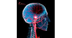 Stem Cell Therapy for Stroke Recovery in Mexico: The Complete Guide to Advanced Regenerative Treatment