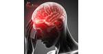 Neurology Stem Cell Treatment in Colombia: An Expert Guide for Medical Tourists