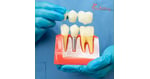 Capitalizing on EU Cross-Border Care: German Medical Tourists Drive Record Demand for Premium Dental Crowns in Croatia